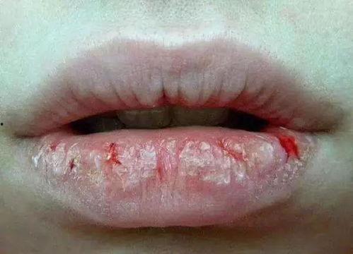 吃网纹瓜嘴唇疼,小心吃后嘴唇疼痛的尴尬